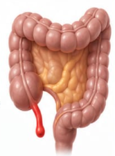 Appendisit